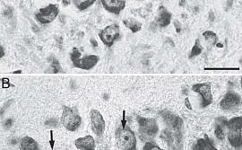 Микрофотографии срезов СА3 поля гиппокампа двух крыс после введения раствора бета-амилоида Аβ25-35 на 45 день. А – без фуллерена C60, B – с введением фуллерена C60. На фото А – можно увидеть поврежденные клетки с нечеткой и раздробленной клеточной и ядерн
